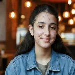 Indian-girl-with-facial-acne